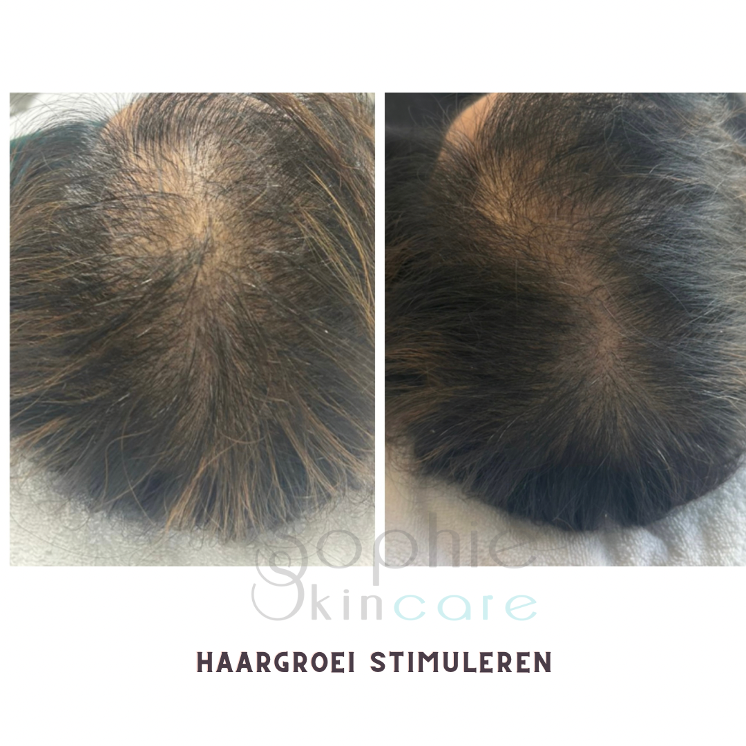 Voor en na: haargroeibehandeling