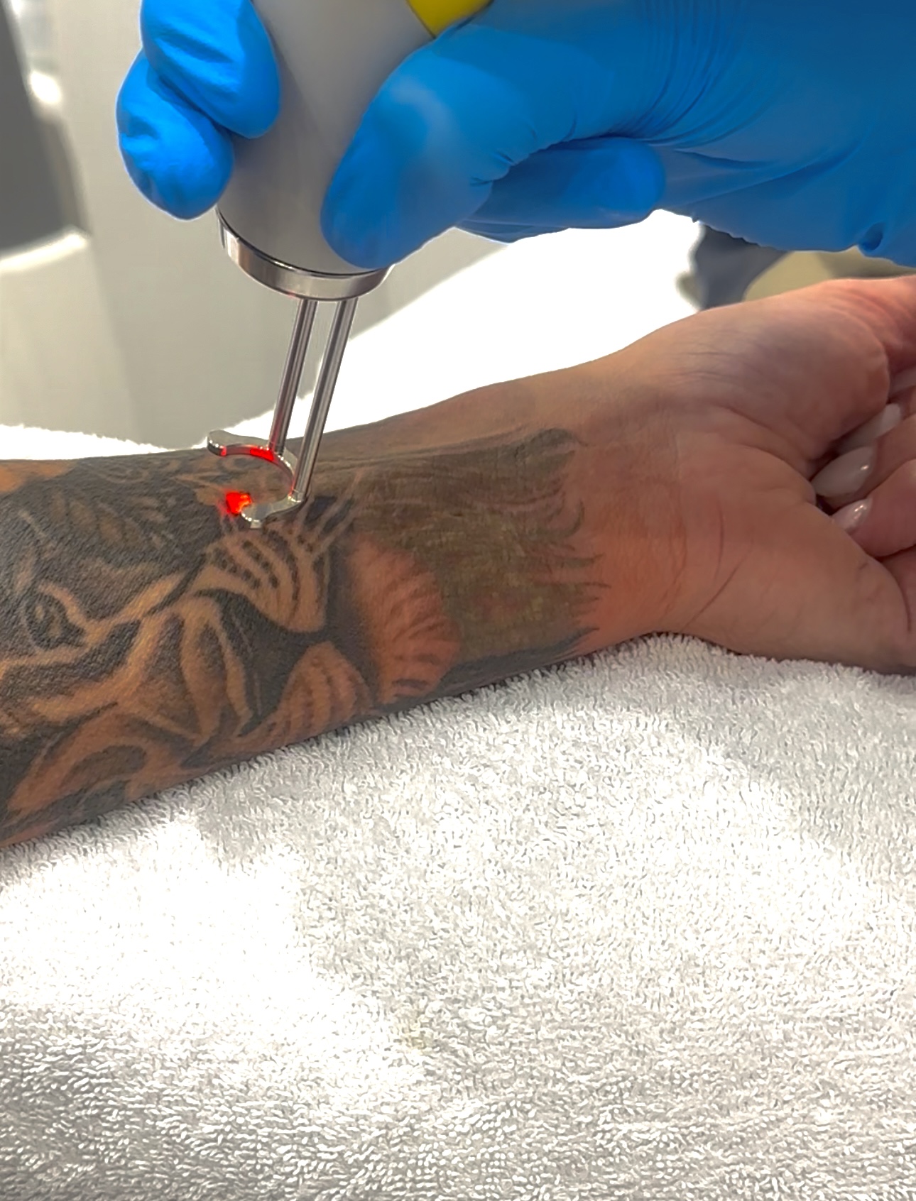 Tattoo verwijderen met de picolaser in de huidkliniek in Voorburg