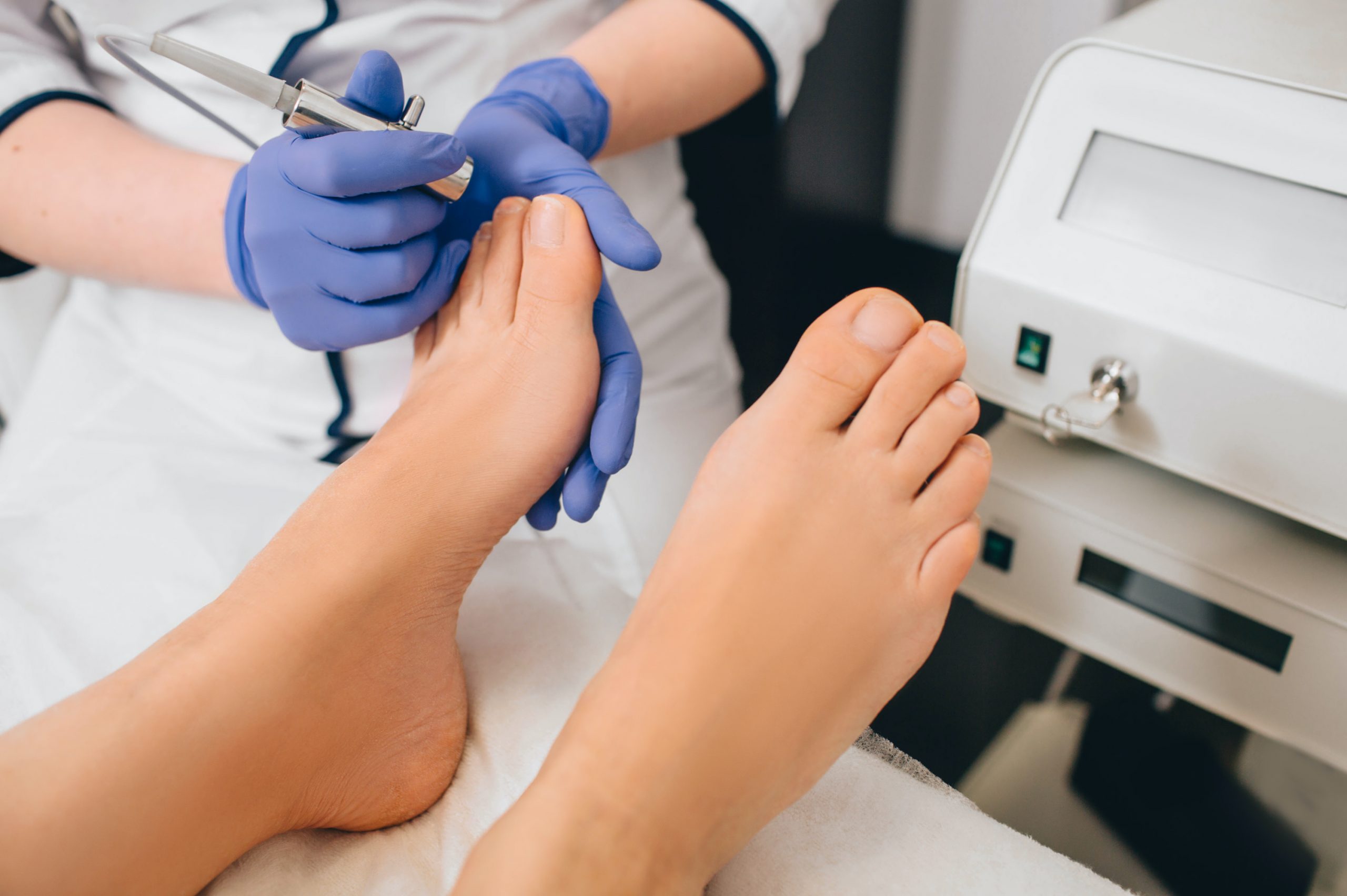 Schimmelnagels laseren bij Sophie Skincare in Voorburg
