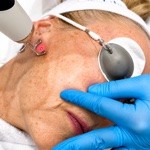 CO2-fractionele laserbehandeling van het gezicht in de huidkliniek in Voorburg
