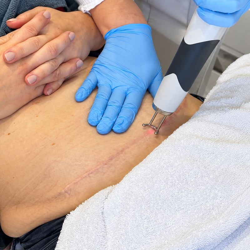 Littekenbehandeling met PicoFractional op de buik